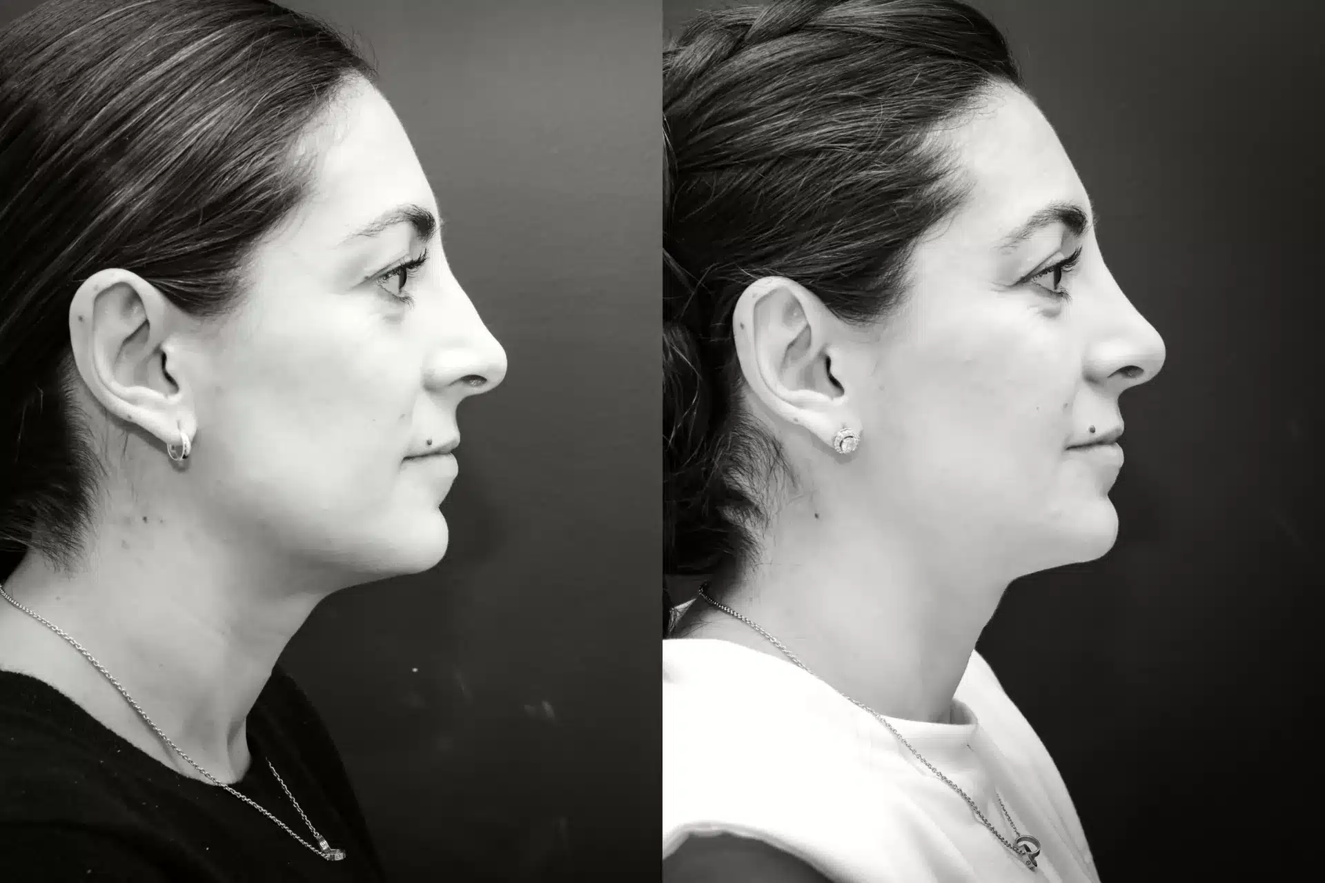 rhinoplasty newport beach