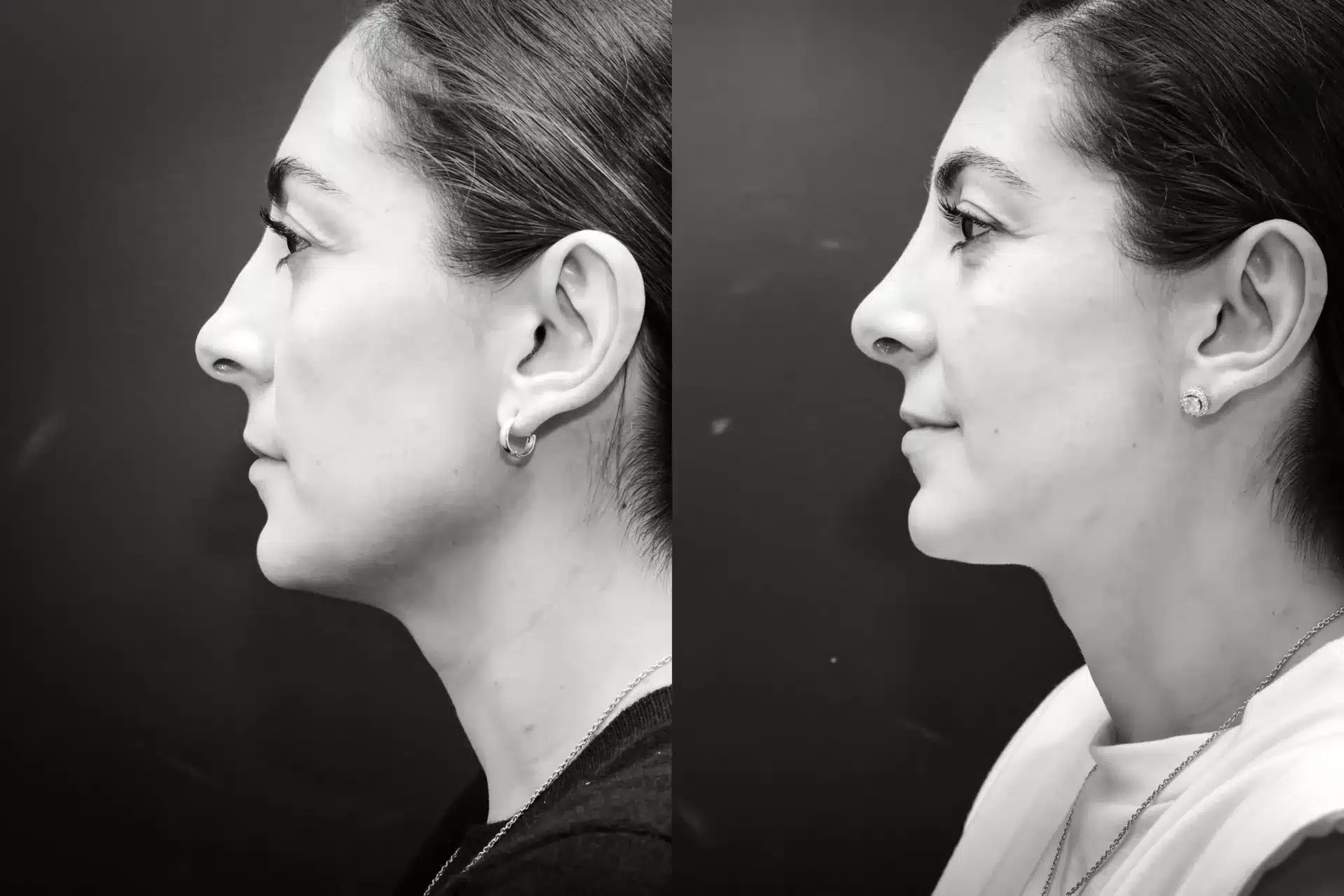 rhinoplasty newport beach