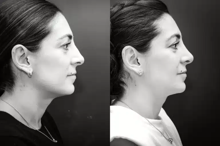 rhinoplasty newport beach