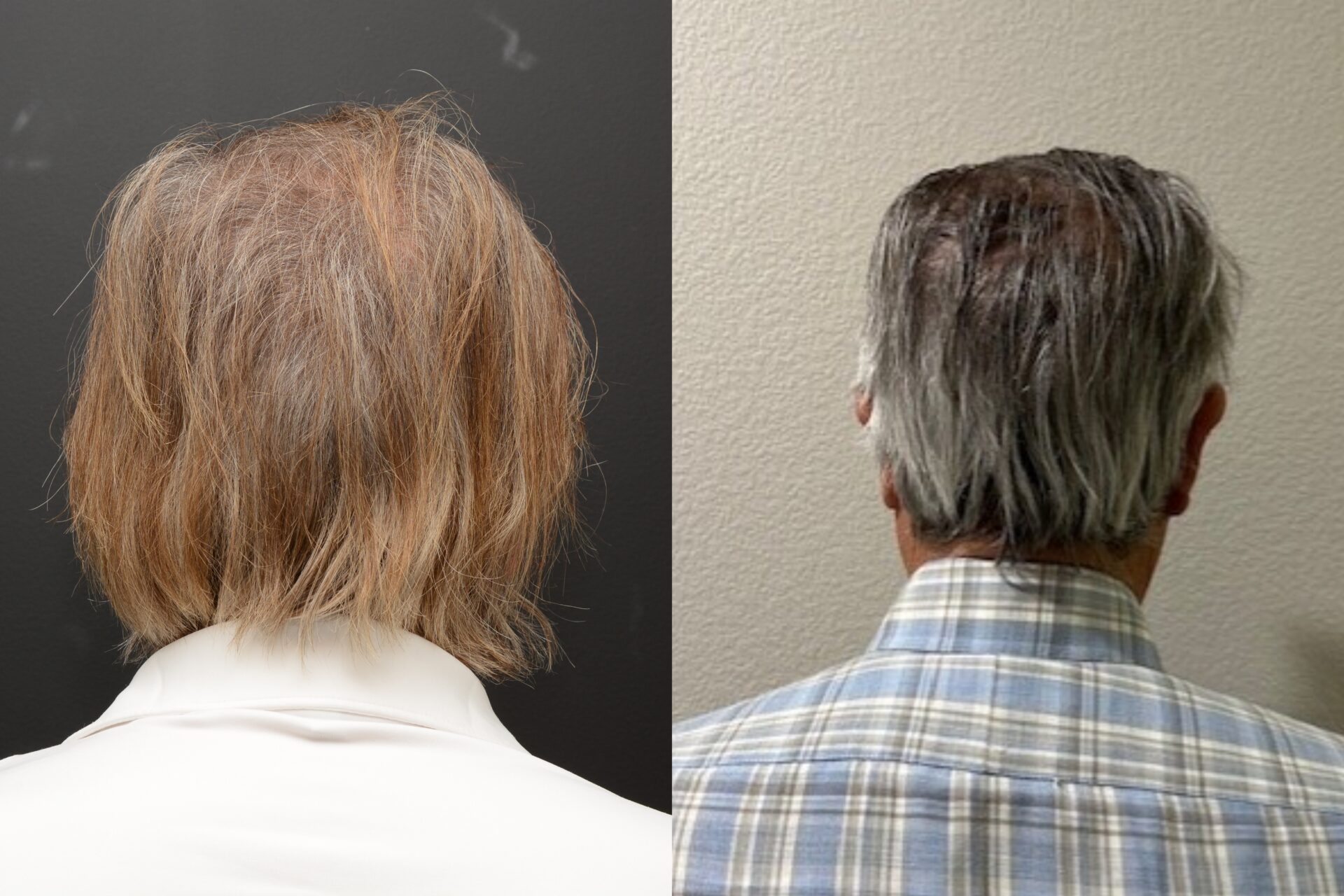 NeoGraft Hair Transplant Newport Beach