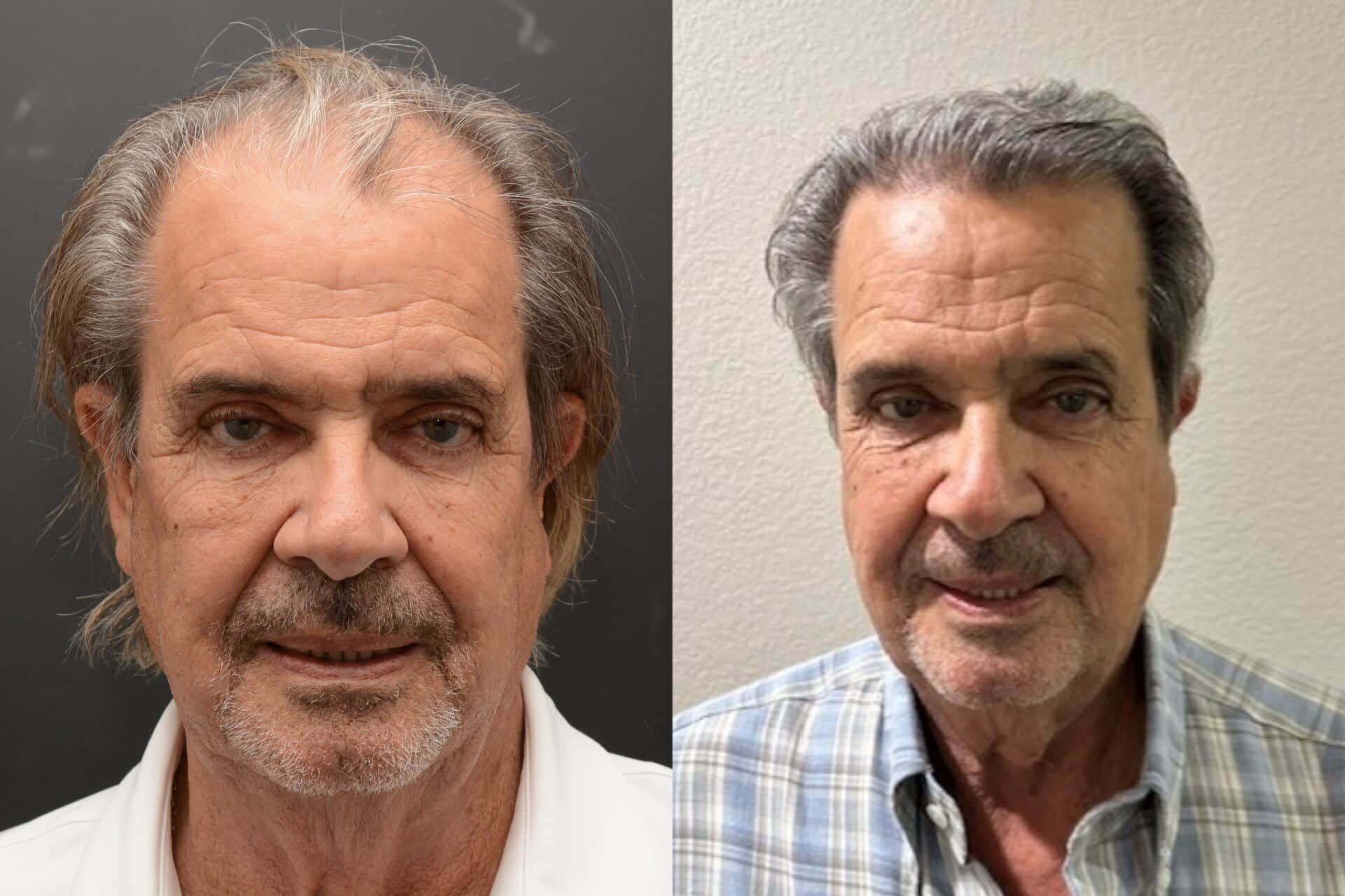 NeoGraft Hair Transplant Newport Beach