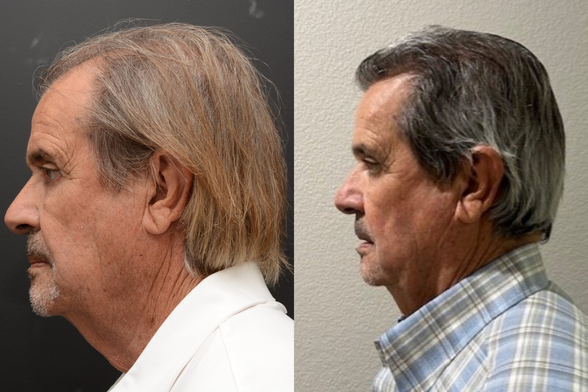 NeoGraft Hair Transplant Newport Beach